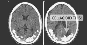 celiac brain stones